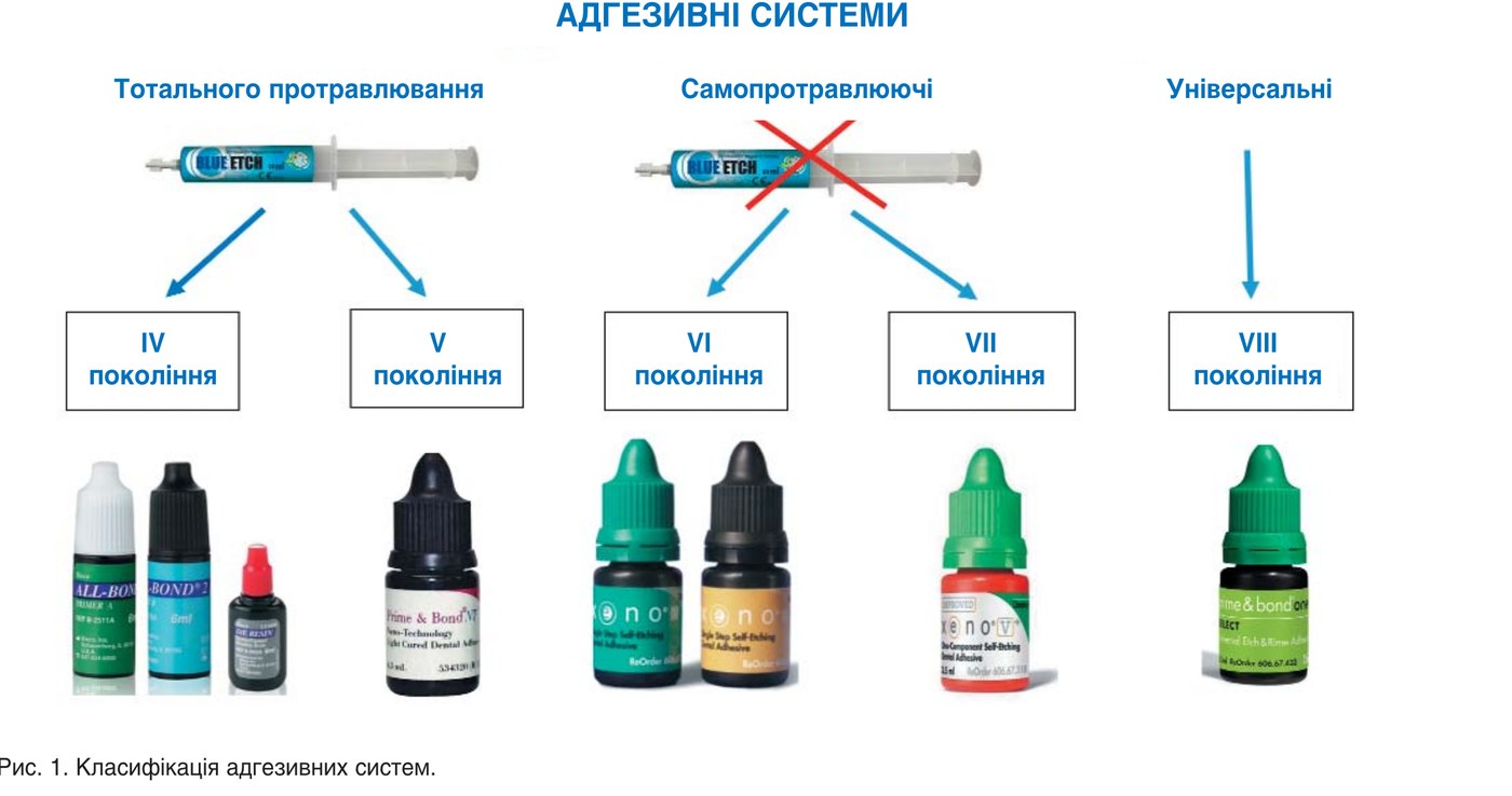 Класифікація адгезивних систем.