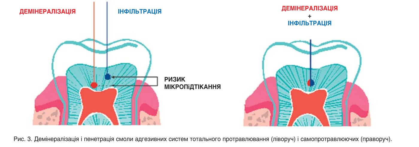 Демінералізація і пенетрація смоли адгезивних систем тотального протравлювання (ліворуч) і самопротравлюючих (праворуч).