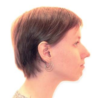 Профіль обличчя пацієнтки Л. М. до лікування.