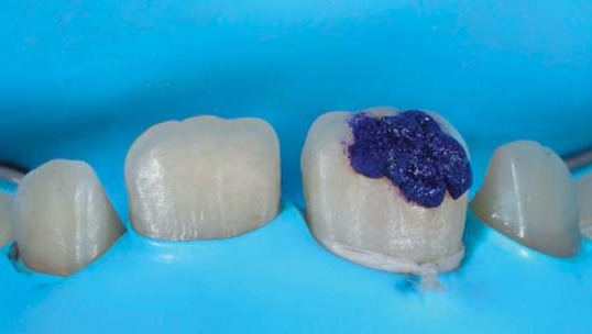 Для мікроабразивної обробки ми скористалися Ultradent Opalustre. На уражений зуб нанесли пасту, а власне обробку обережно робили «чашечками» на швидкості приблизно 500 об/хв. Процедура тривала 60 секунд, після чого зуб промили водою.