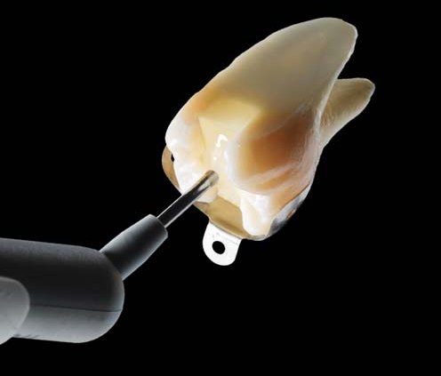 Заповнення SDR Plus Bulk Fill Flowable Composite на розрізі зуба ілюструє чудову адаптацію матеріалу в проксимальному відділі та до стінок порожнини