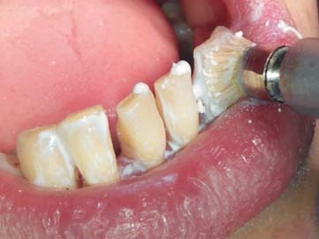 I етап — втирання пасти Nupro Sensodyne