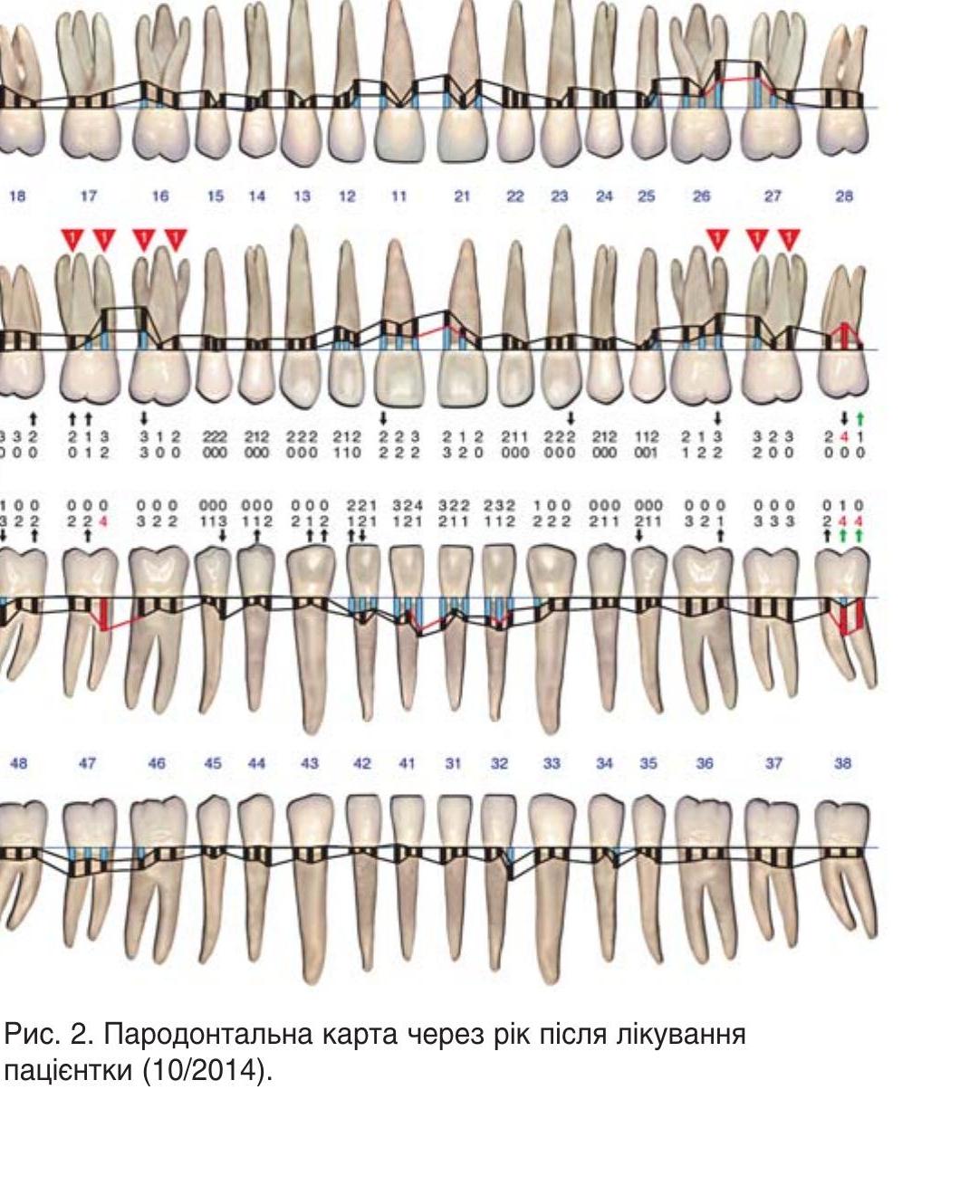 Пародонтальна карта через рік після лікування пацієнтки