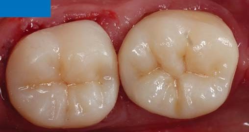 Дві керамічні накладки CEREC Tessera після лікування.