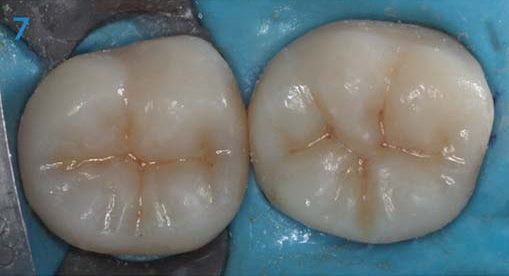 Зафіксовано дві керамічні накладки CEREC Tessera.