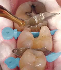 Клінічні етапи реставрації дефектів Класу II за протоколом Dentsply Sirona