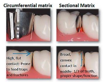 Клінічні етапи реставрації дефектів Класу II за протоколом Dentsply Sirona