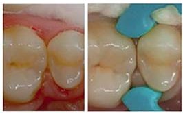 Клінічні етапи реставрації дефектів Класу II за протоколом Dentsply Sirona