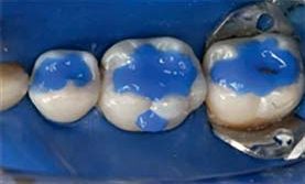 Клінічні етапи реставрації дефектів Класу II за протоколом Dentsply Sirona
