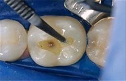 Клінічні етапи реставрації дефектів Класу II за протоколом Dentsply Sirona