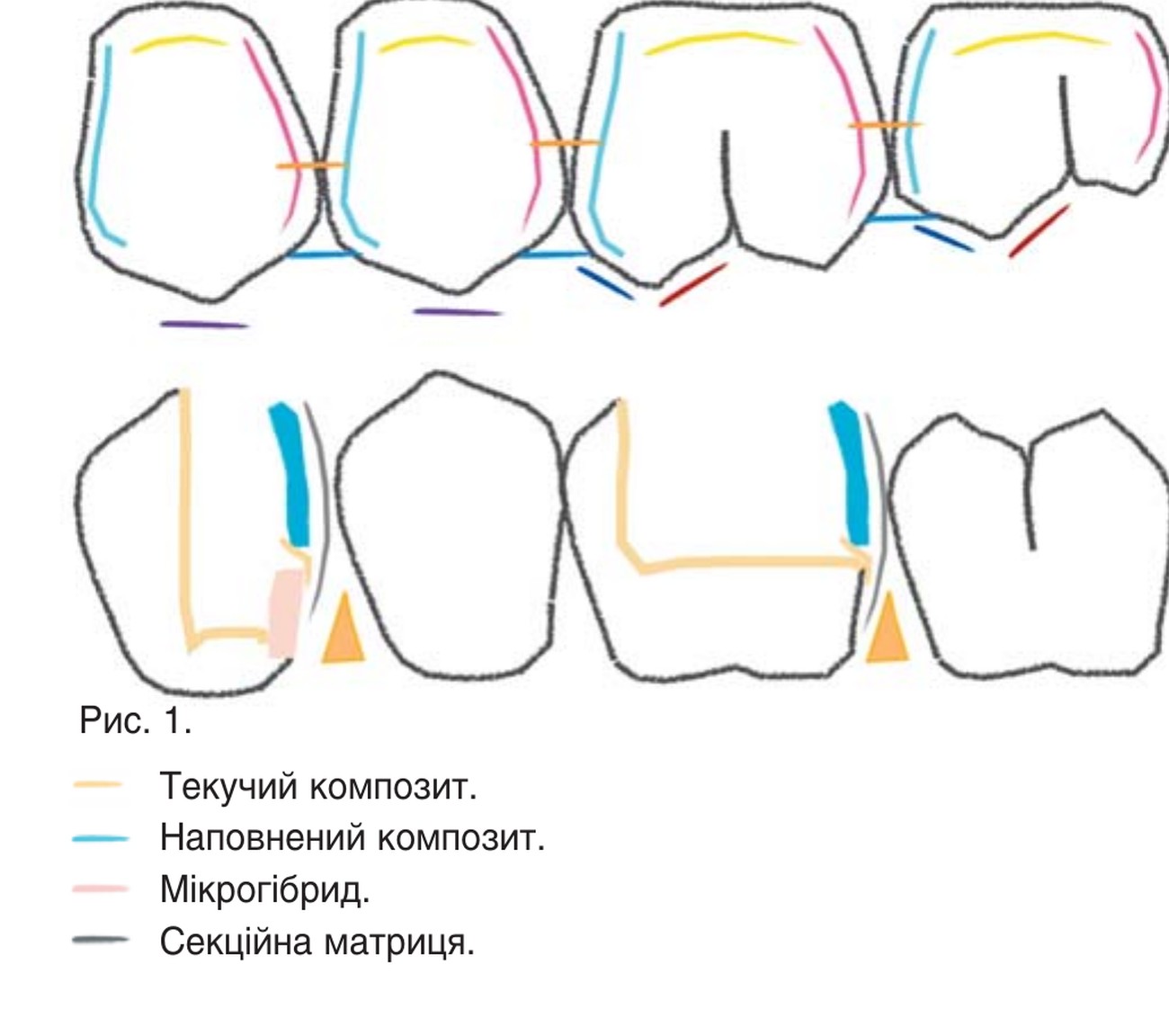 Рис. 1. Текучий композит, наповнений композит, мікрогібрид, секційна матриця.