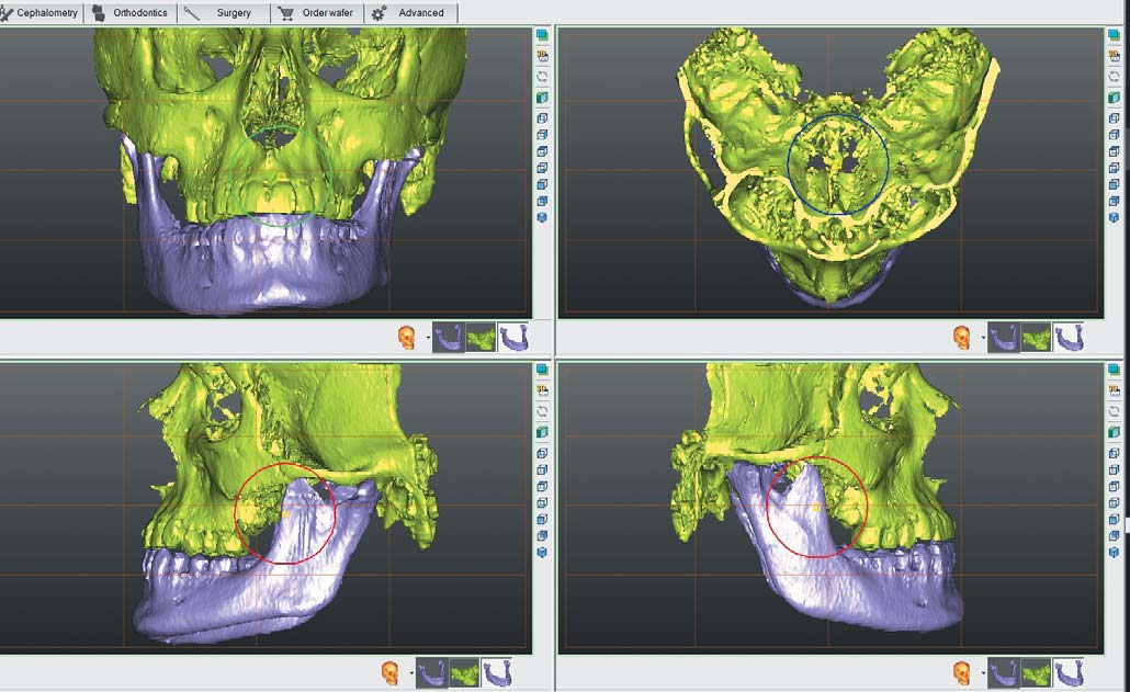 3D-моделі нижньої щелепи з візуалізацією асиметрії