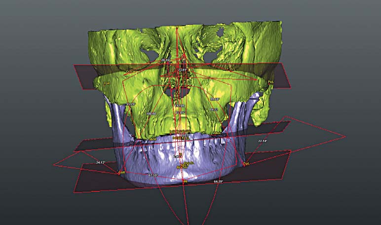 3D-модель черепа з площинами вимірювання