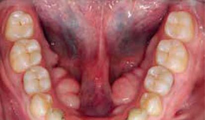 Клінічний випадок 2: превентивне лікування стирання зубів з віддаленими результатами 11 років