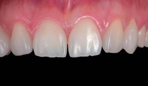 (б). Здорові м'які тканини й відсутність крайового забарвлювання підтверджують правильність обраного варіанту лікування.