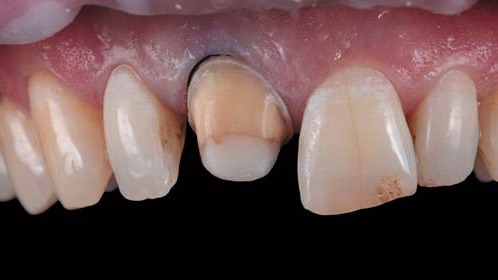 Фото відпрепарованого зуба без поляризаційного фільтра.