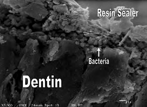 Деградація адгезивного з'єднання з використанням системи Resilon