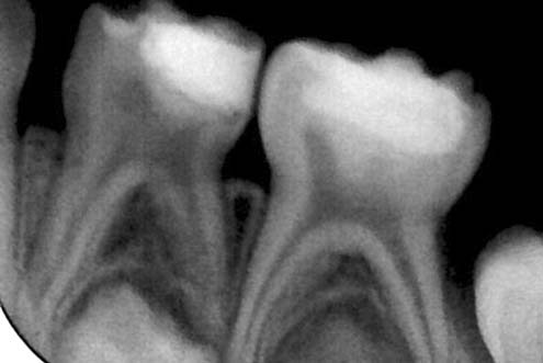 Пряме покриття пульпи зубів 84, 85 матеріалом Biodentine