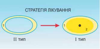 Трансформація II типу зруйнованості кореня в I тип. 1 — дентин кореня; 2 — композитний матеріал для прямих реставрацій.