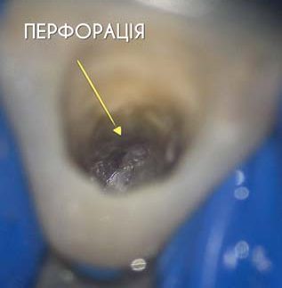 Сходинка та перфорація (позначено стрілкою).