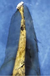 Фото 3-5: апікальна третина кореневого каналу з обтураційним матеріалом, Aspergillus fumigatus, аспергильоз верхньощелепного синуса