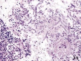 Фото 3-5: апікальна третина кореневого каналу з обтураційним матеріалом, Aspergillus fumigatus, аспергильоз верхньощелепного синуса