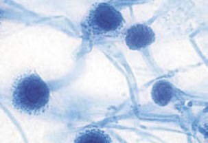 Фото 3-5: апікальна третина кореневого каналу з обтураційним матеріалом, Aspergillus fumigatus, аспергильоз верхньощелепного синуса