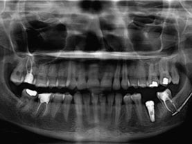 Фото 6: клінічний випадок екструзії силера в нижньощелепний канал при лікуванні зуба 37