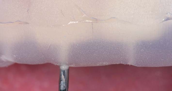 Прозорий ключ міцно зафіксовано; текучий композит (Enamel Plus HRi Flow, Micerium) введено крізь отвір і заполімеризовано прямо через ложку.