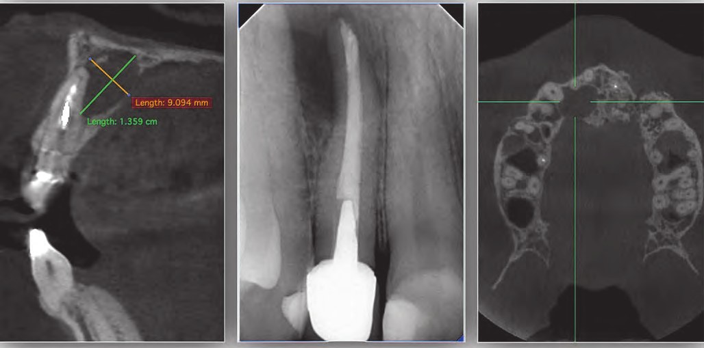 Стан слизової оболонки 1 квадранта. Нориця (sinus tract) у проєкції зуба 12.