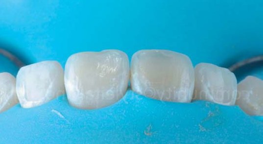 Зуби ізольовані рабердамом, з фіксацією клампів на верхніх премолярах. Зуби було очищено профілактичною щіткою, а потім, щоб підготувати їх до циклів протравлювання, оброблено легким струменем оксиду алюмінію 27 мкм за допомогою Aquacare. Також слід було провести абразивну обробку наявних пломб, щоб підготувати поверхню до адгезії.