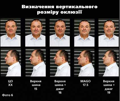 Визначення вертикального розміру оклюзії
