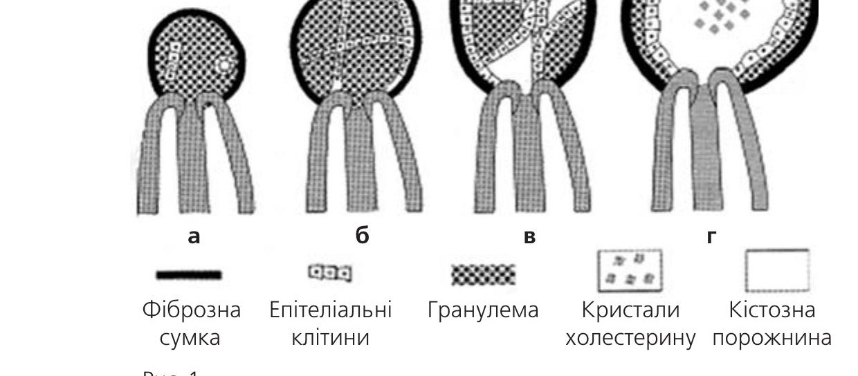 Рис. 1. Фіброзна сумка, епітеліальні клітини, гранулема, кристали холестерину, кістозна порожнина