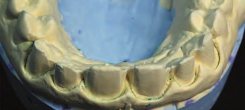 Після ретракції за допомогою Astringent Retraction Paste. Сформовано новий контур ясен, який у подальшому буде адаптуватися під нову форму коронки.