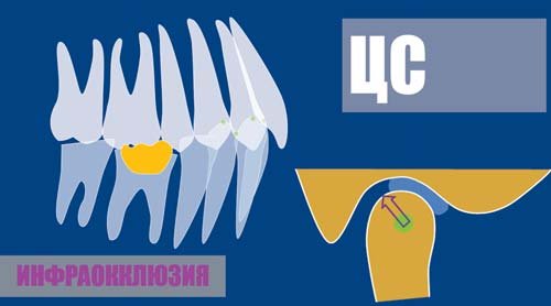 Схема: звична оклюзія = центральне співвідношення