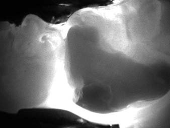 Зображення зуба 21 за допомогою Diagnocam