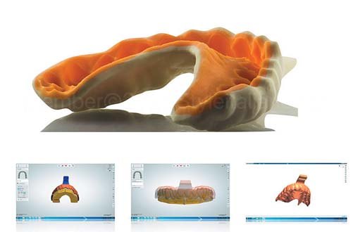 Цифровий wax-up у програмі exocad і 3D-друк моделей верхньої і нижньої дуг для наступного перебазування рідким силіконом