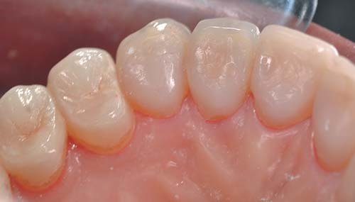 Ось такий вигляд мають функціональні вініри через півроку.
