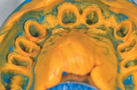 Відтиск знято в двоетапній техніці putty-wash з використанням матеріалів light body і putty (Honigum Mixstar Heavy, Honigum Light, DMG, м. Гамбург).