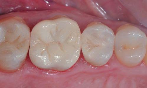 Вигляд зафіксованих керамічних реставрацій.