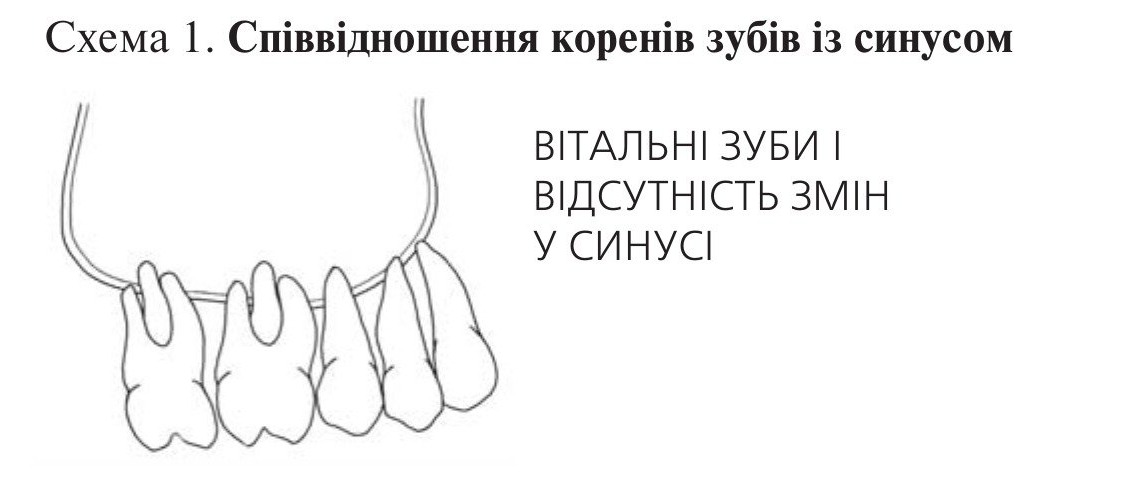 Схема 1. Співвідношення коренів зубів із синусом