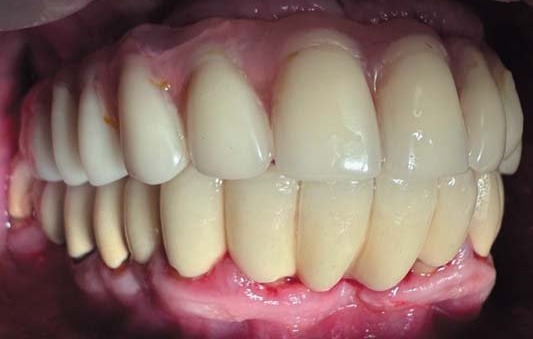 –3.