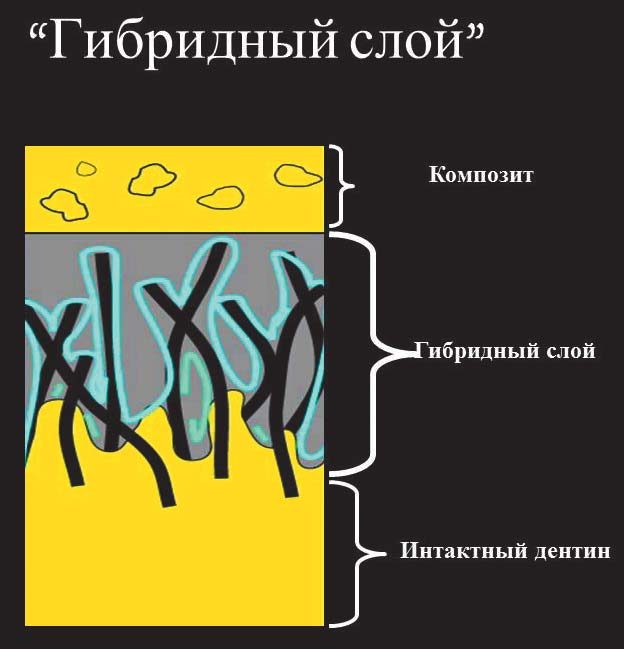 Схематичне зображення гібридного шару: композит — гібридний шар — інтактний дентин.