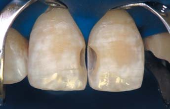 Об’єм дентину імітувався відтінком D2 матеріалу Ceram-XOne Dentin & Enamel. Неоднорідність поверхні, притаманна флюорозним зубам, створювалася за допомогою аплікатора. Для цього в піднутрення у композит було внесено білу фотополімерну фарбу для імітації флюорозних крейдоподібних плям.