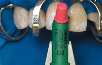 Об’єм дентину імітувався відтінком D2 матеріалу Ceram-XOne Dentin & Enamel. Неоднорідність поверхні, притаманна флюорозним зубам, створювалася за допомогою аплікатора. Для цього в піднутрення у композит було внесено білу фотополімерну фарбу для імітації флюорозних крейдоподібних плям.
