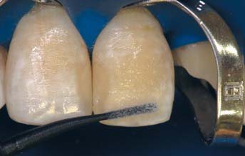 Об’єм дентину імітувався відтінком D2 матеріалу Ceram-XOne Dentin & Enamel. Неоднорідність поверхні, притаманна флюорозним зубам, створювалася за допомогою аплікатора. Для цього в піднутрення у композит було внесено білу фотополімерну фарбу для імітації флюорозних крейдоподібних плям.
