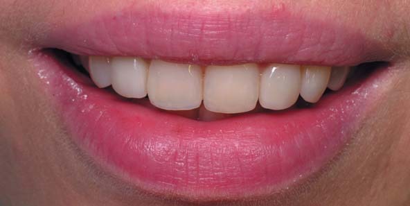 Усмішка через два тижні після реставрації