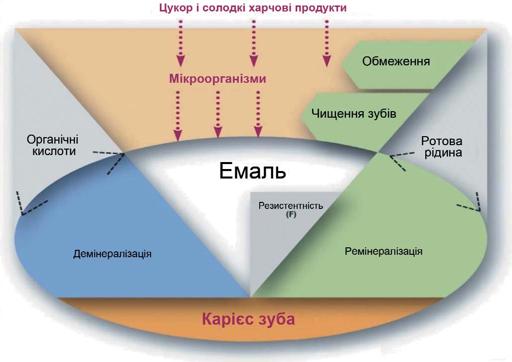 Схема патогенезу карієсу зубів
