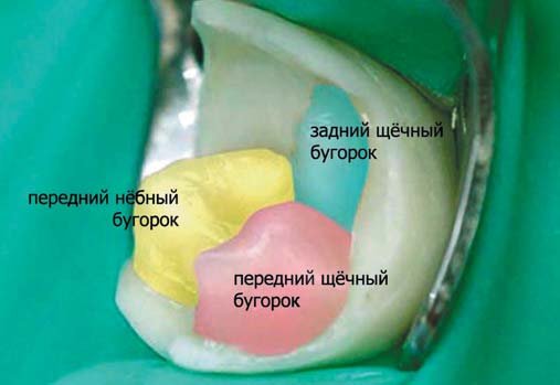 Крок моделювання коронкової частини першого моляра верхньої щелепи