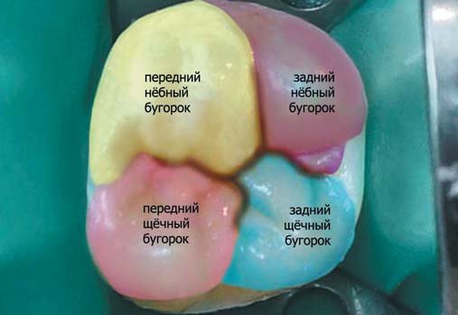 Крок моделювання коронкової частини першого моляра верхньої щелепи